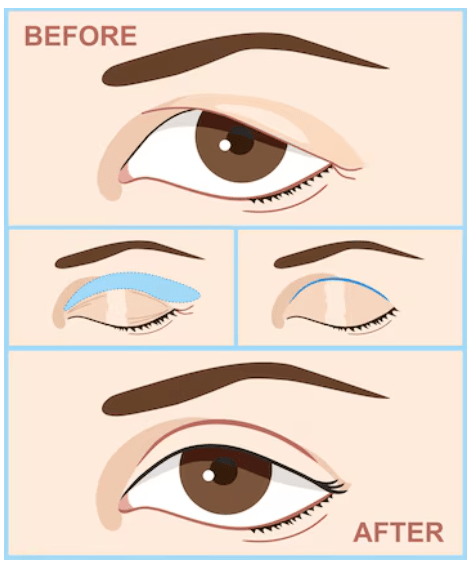 blepharoplasty-results