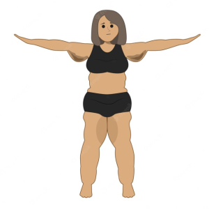 lipedema