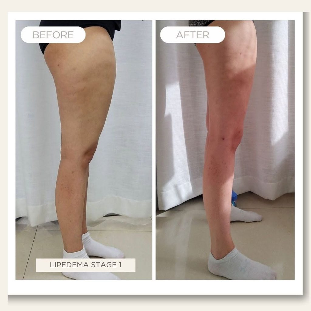 lipedema before after treatment