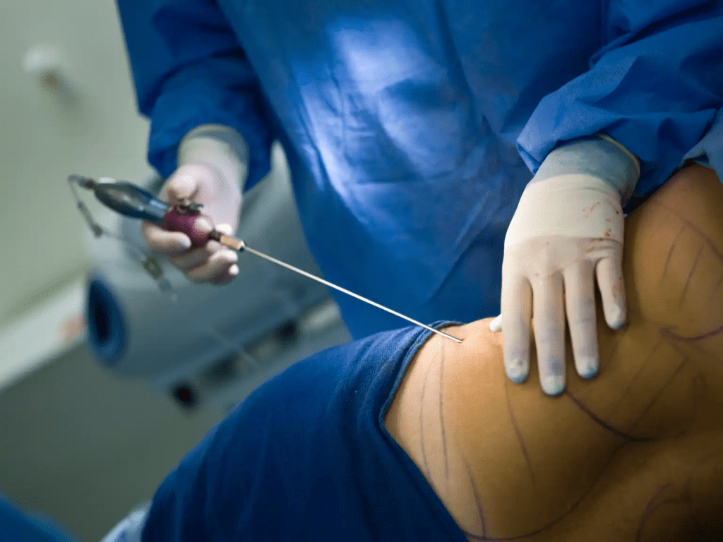 pal liposuction for lipedema