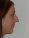 Rhinoplasty Patient